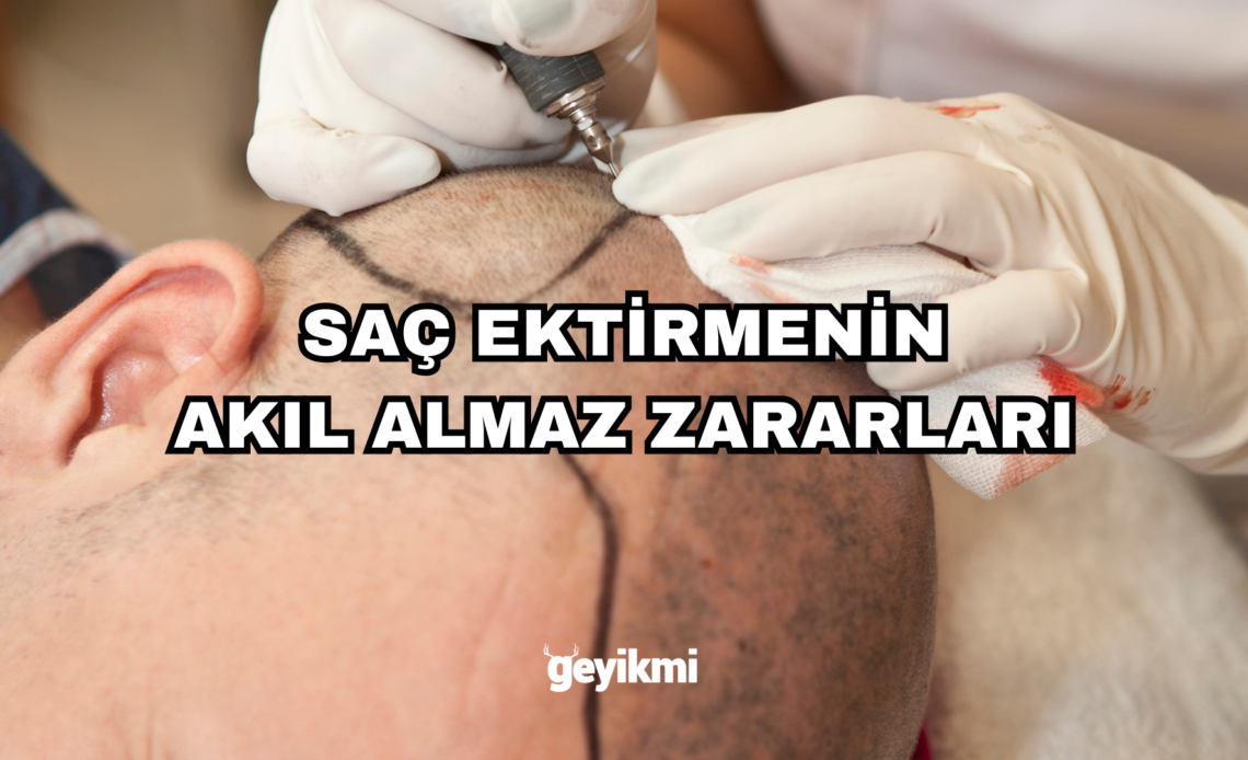 Saç ektirmenin zararı var mı? 7 Başlıkta Saç Ekimi